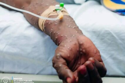 Santé : La RDC reçoit 1,5 million de doses du vaccin LC16m8 contre la Mpox